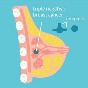 Τριπλά αρνητικός καρκίνος του μαστού