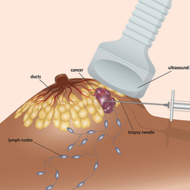 Core Biopsy: Μια Σημαντική Διαγνωστική Μέθοδος για τον Μαστό